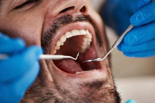 Best Emergency Dental Extractions in Southgate, FL